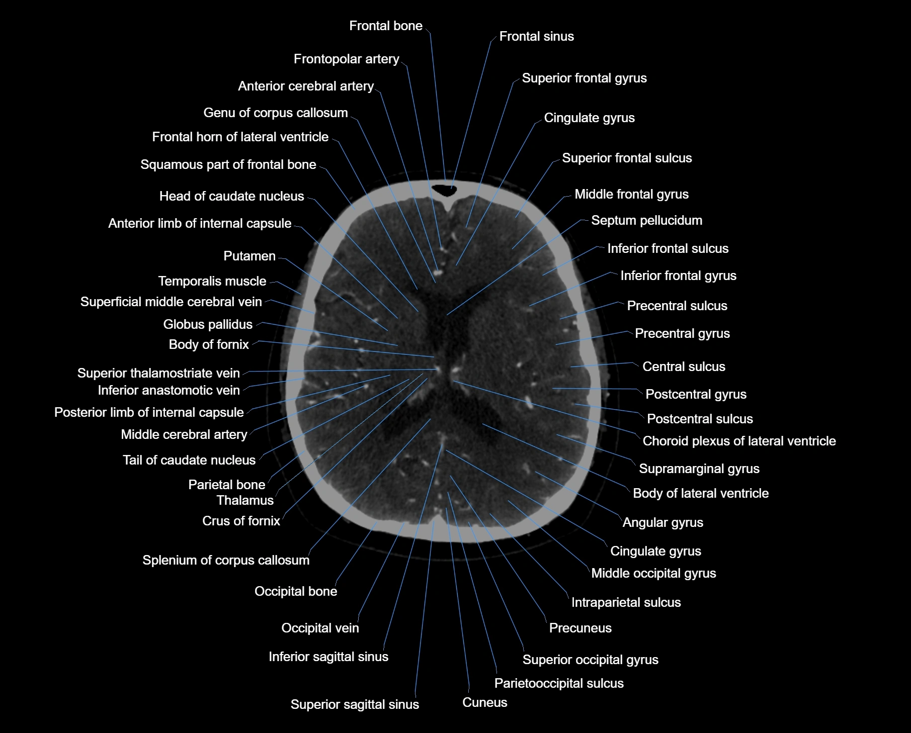 CT scan brain axial labelled cross sectional anatomy image-img-000041.webp